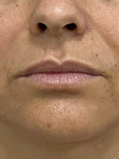 Bigode Chinês 1 - Depois