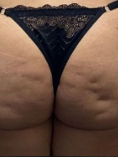 Bioestimulador - foto antes