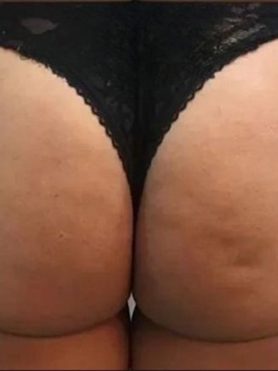 Bioestimulador - foto depois