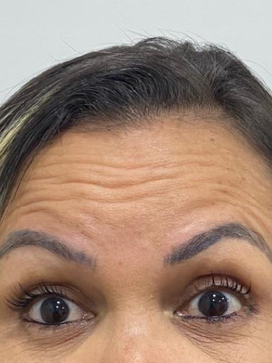 Botox - Antes