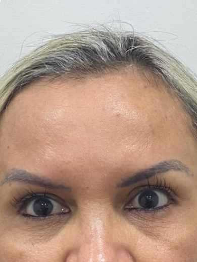 Botox - Depois