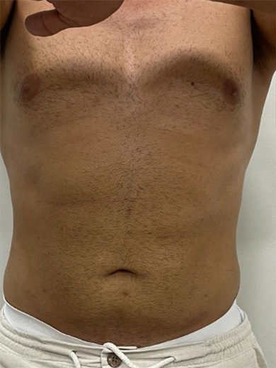 Criodermis 2.0 - Antes