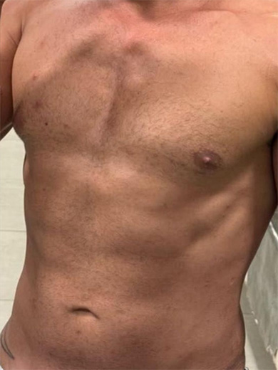 Criodermis 2.0 - Depois