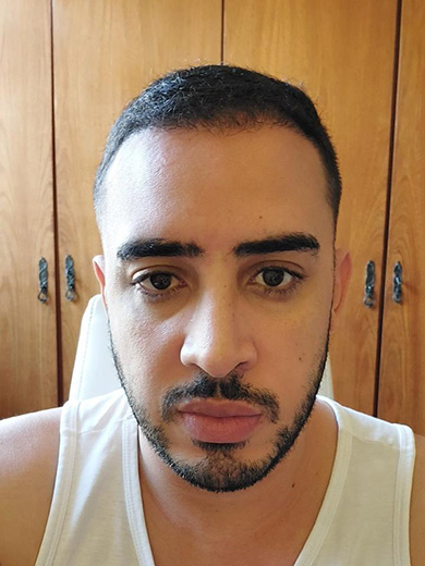 Harmonização Facial 1 - Antes