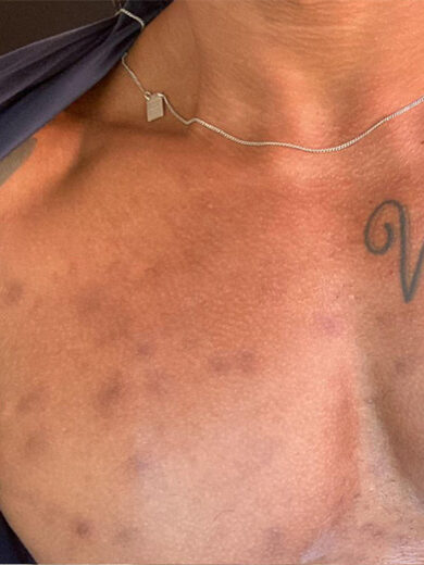 Laser Lavieen - Antes