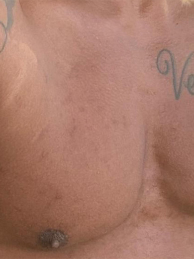 Laser Lavieen - Depois