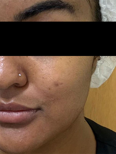 Laser Lavieen rosto - Antes