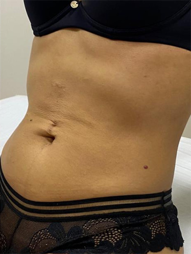 Method Harmony 2 - Depois