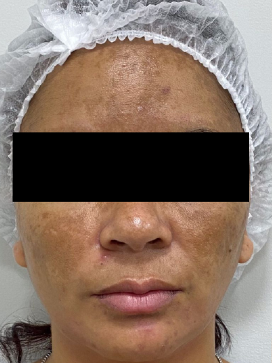 Peeling Evolution - Antes