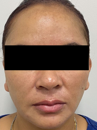 Peeling Evolution - Depois