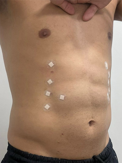 Preenchimento Abdominal - Depois