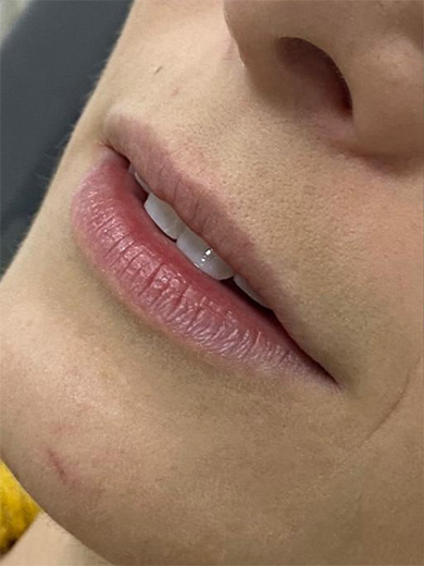 Preenchimento Labial 1 - Antes