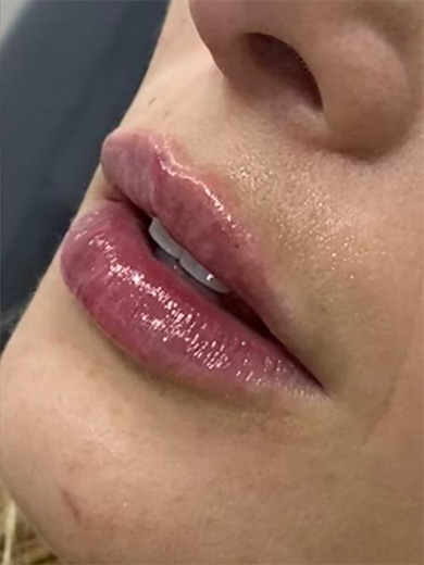 Preenchimento Labial 1 - Depois