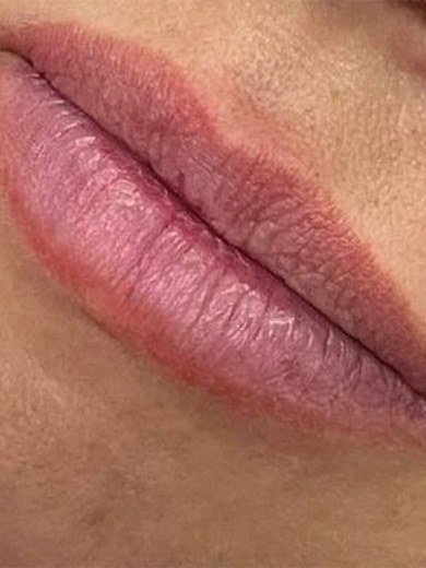 Preenchimento Labial 3 - Antes