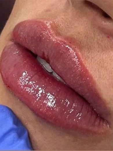 Preenchimento Labial 3 - Depois