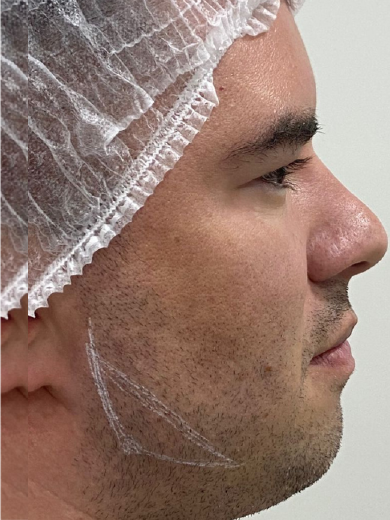 Preenchimento de Mandíbula 1 - Antes