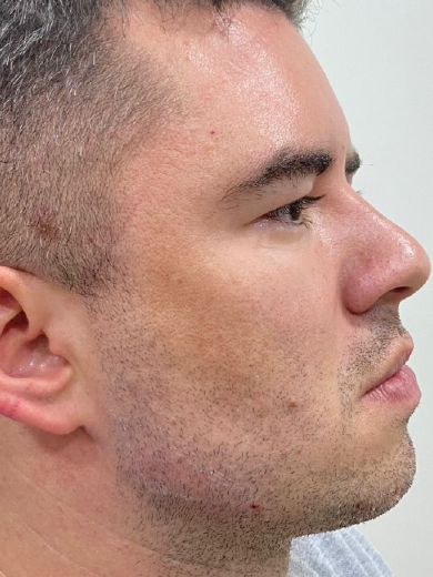 Preenchimento de Mandíbula 1 - Depois