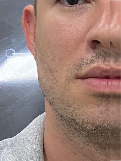 Preenchimento de Mandíbula 2 - Depois