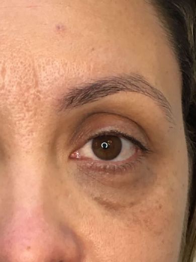 Preenchimento de Olheiras - Antes