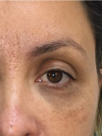 Preenchimento de Olheiras - Depois