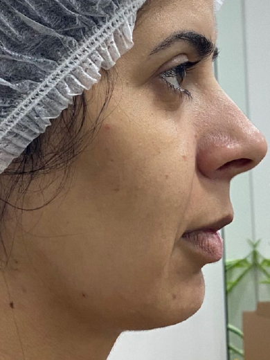 Preenchimento de Queixo - Antes