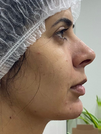 Preenchimento de Queixo - Depois