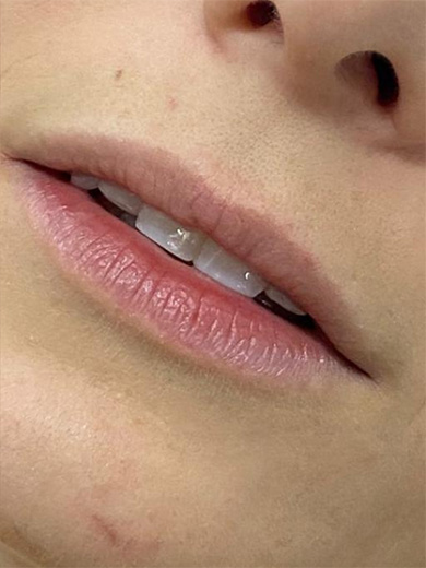 Preenchimento labial 2 - Antes