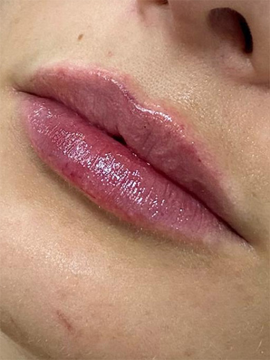 Preenchimento labial 2 - Depois